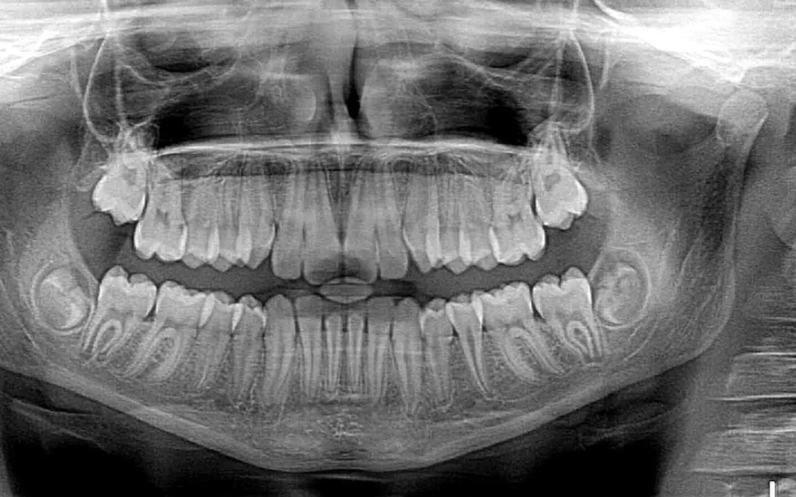 Xray x-ray, x-ray and roentgen